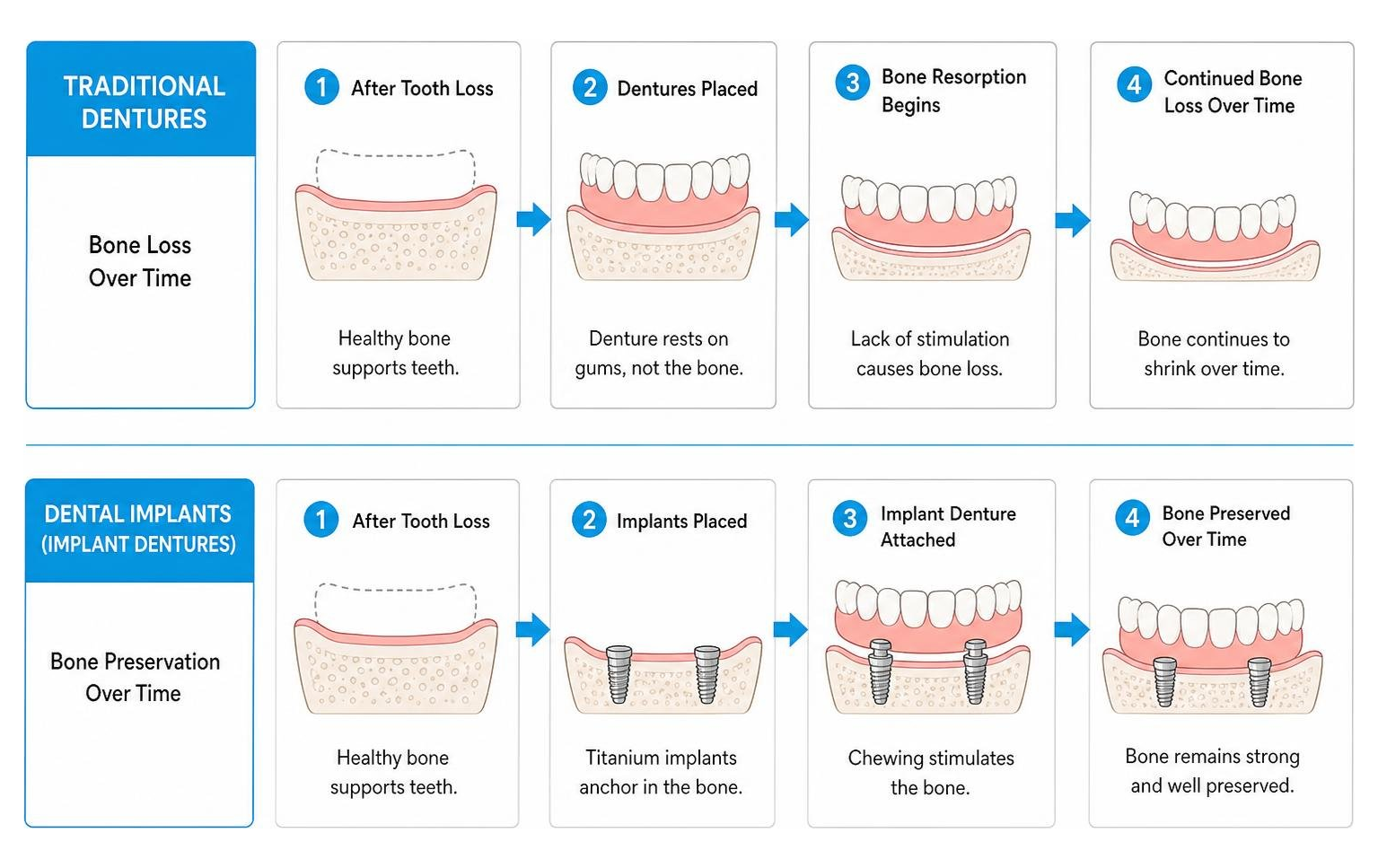 Comparison process of bone retention in traditional dentures vs dental implants Comparison process of bone retention in traditional dentures vs dental implants