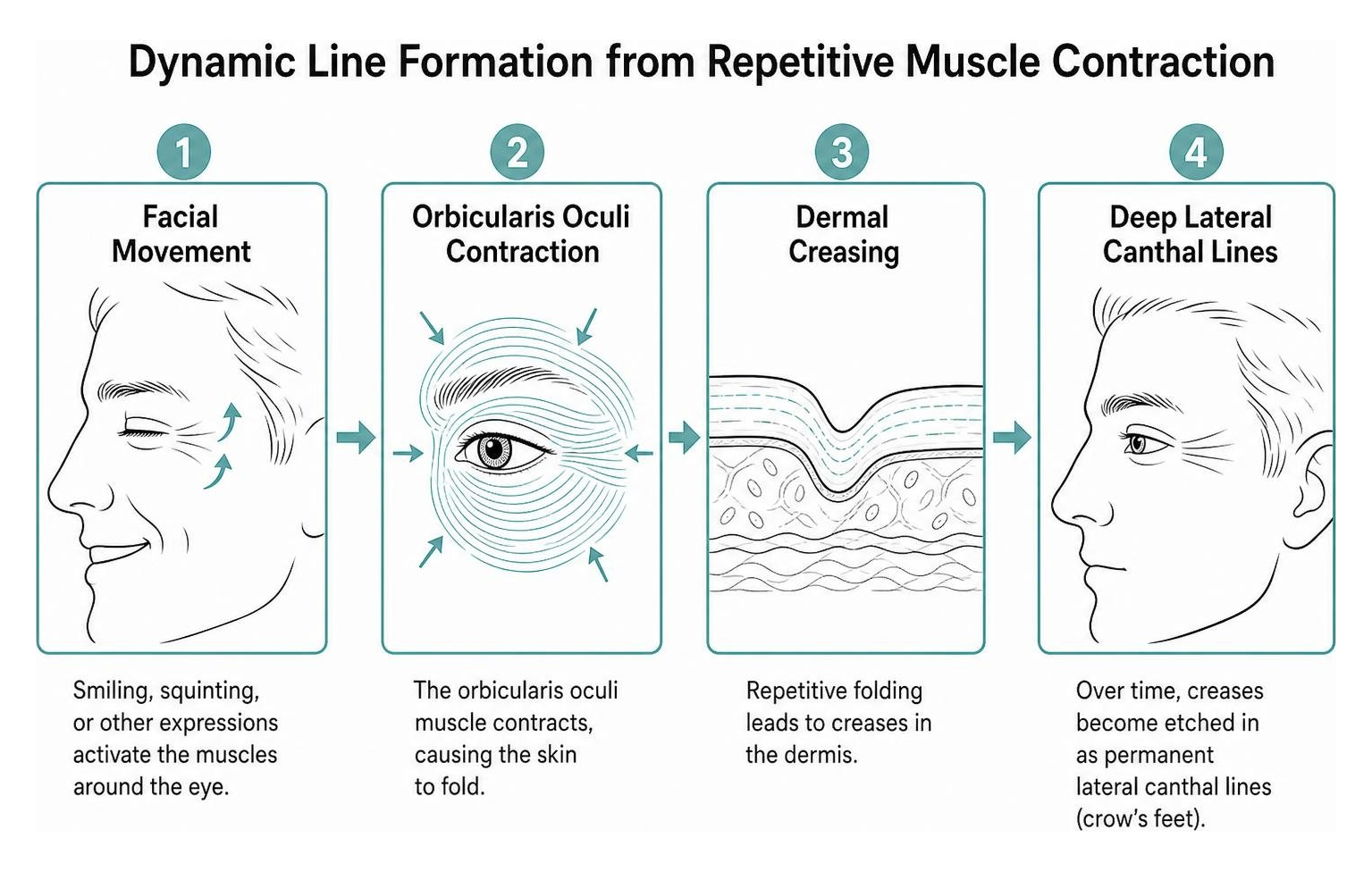 Diagram of dynamic line formation from repetitive muscle contraction