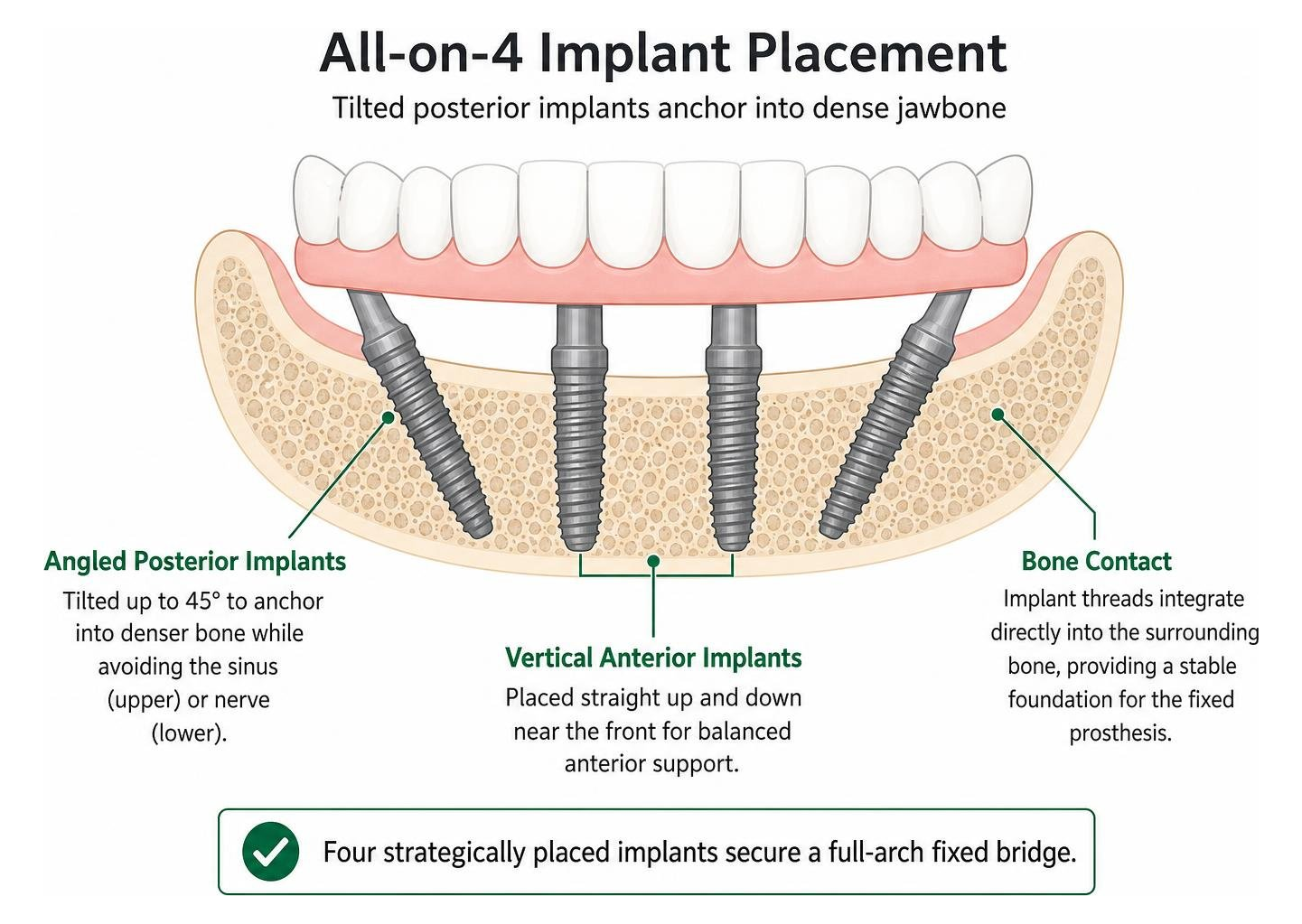 Diagram of tilted posterior implants anchoring into dense jawbone