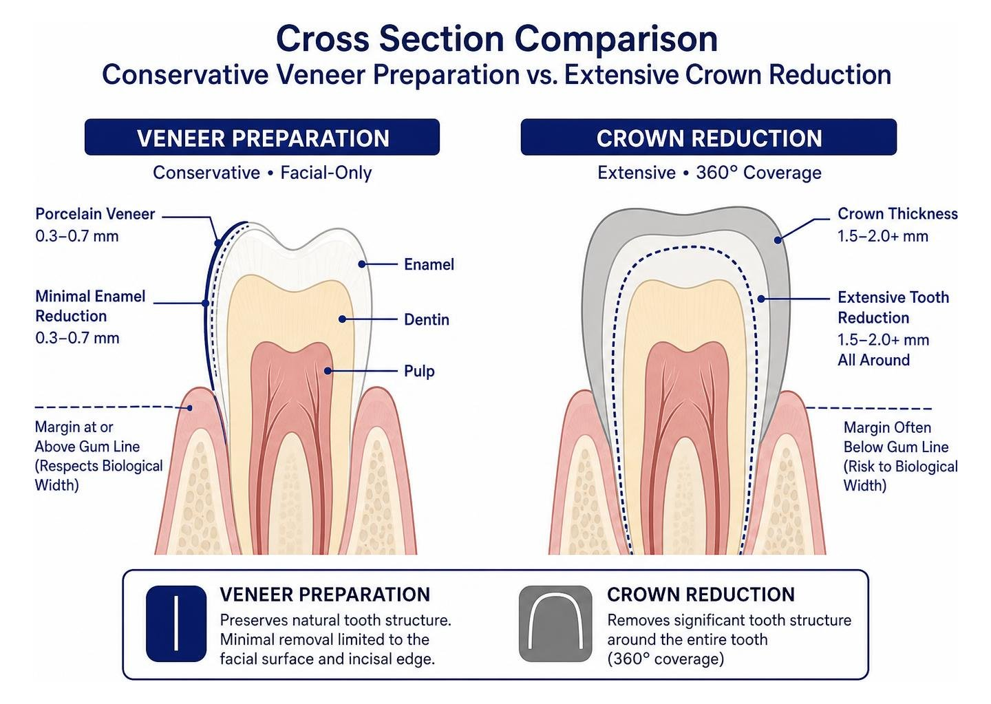 Cross section comparison showing conservative veneer preparation versus extensive crown reduction