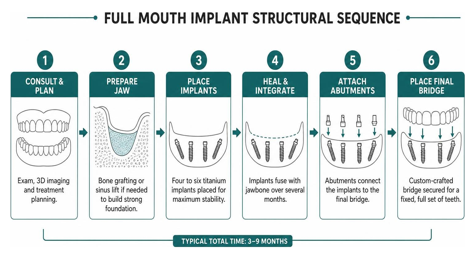 Full mouth implant structural sequence diagram