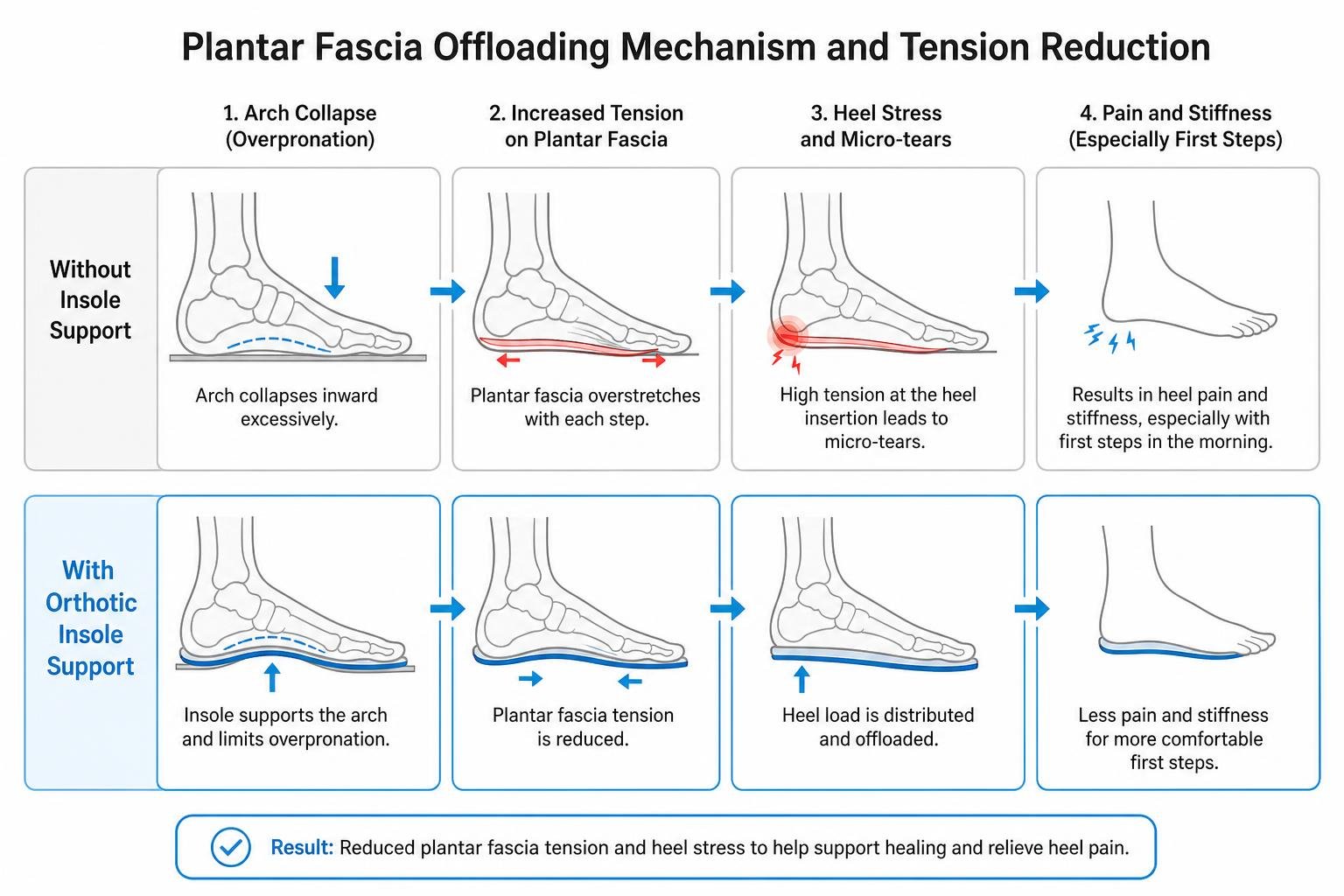 Plantar fascia offloading mechanism and tension reduction Plantar fascia offloading mechanism and tension reduction