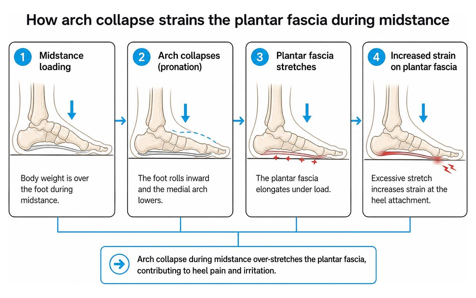 How arch collapse strains the plantar fascia during midstance How arch collapse strains the plantar fascia during midstance