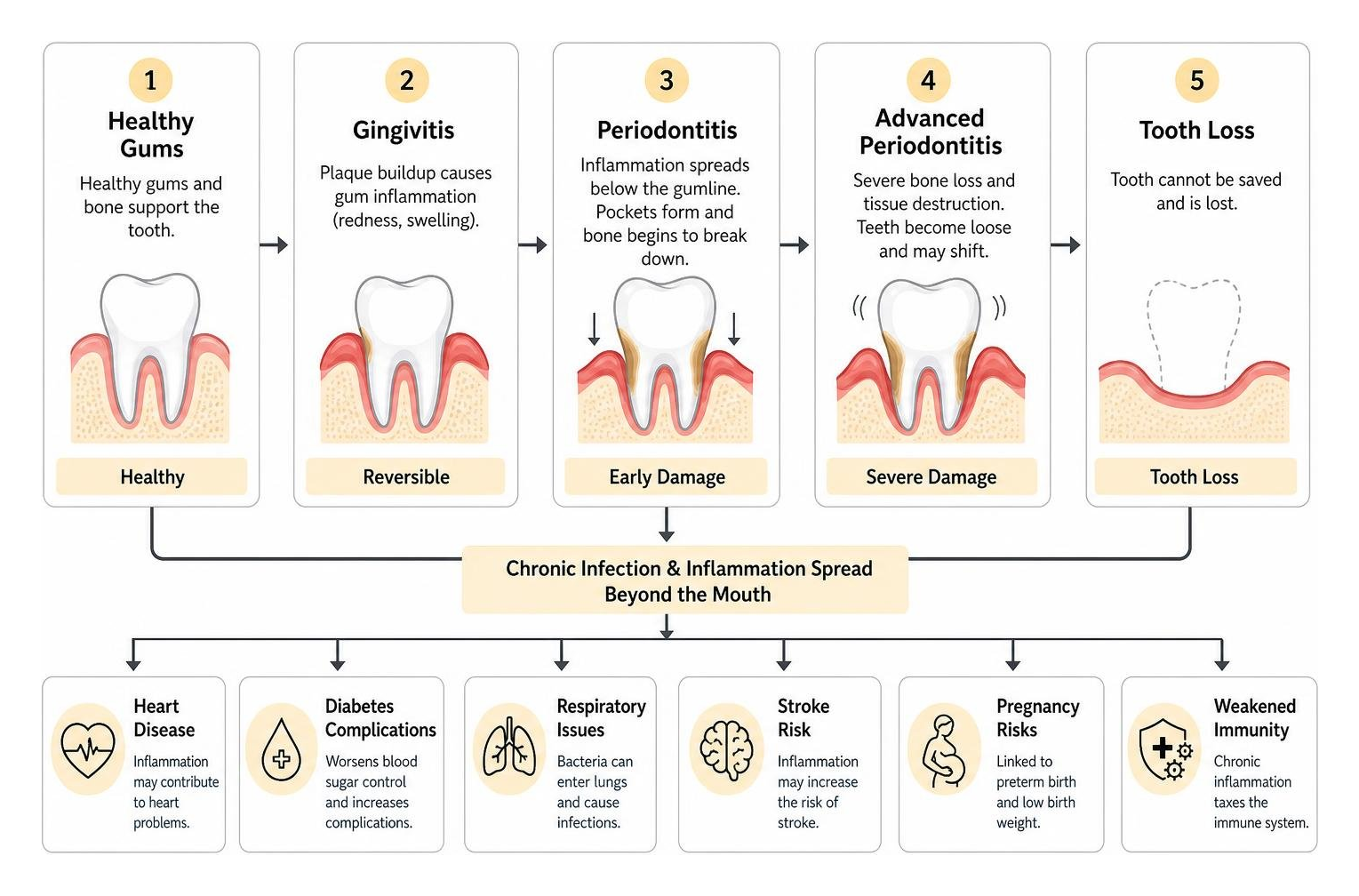 Diagram showing how untreated periodontitis leads to tooth loss and systemic health complications