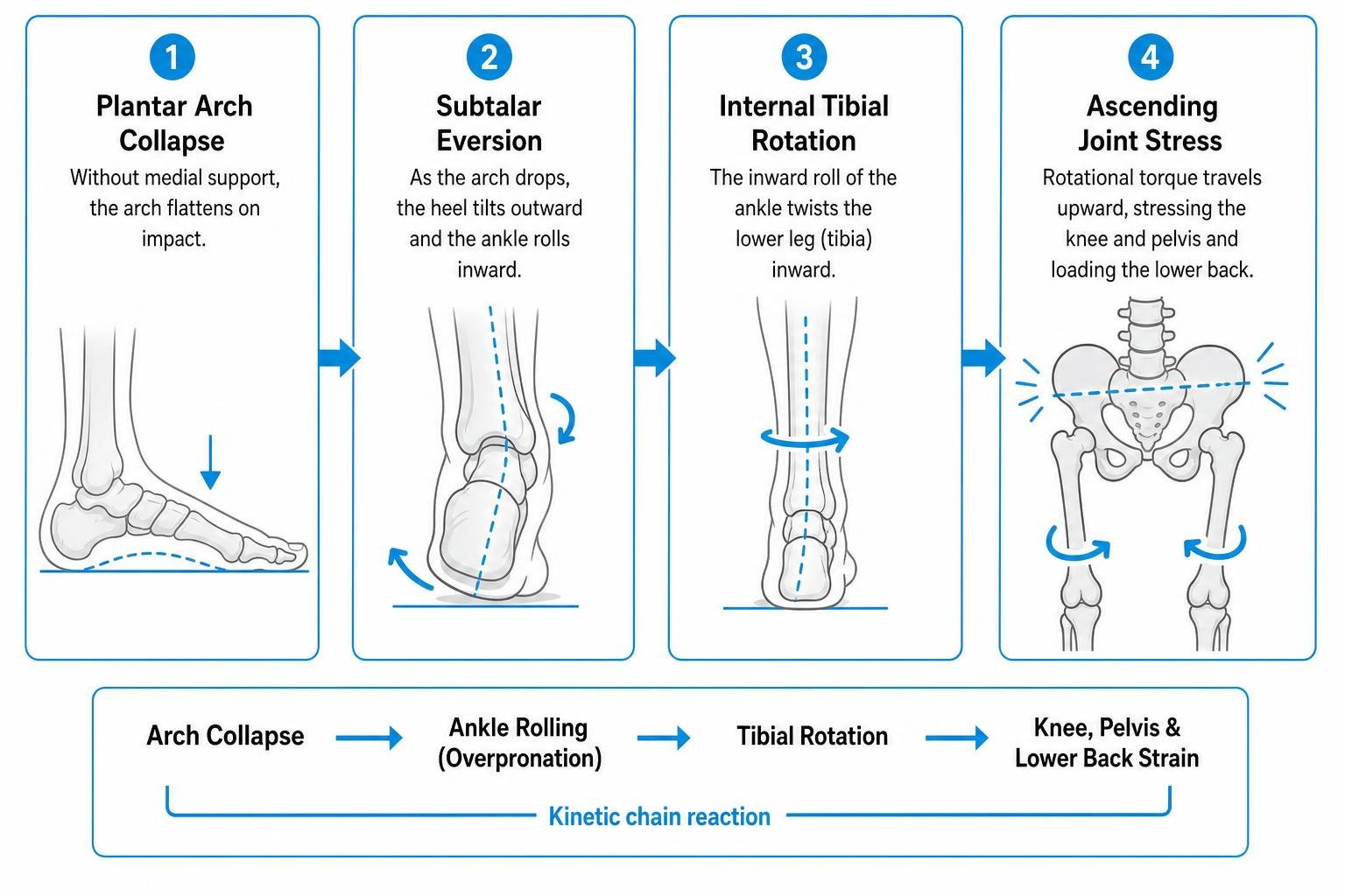 Diagram showing how arch collapse triggers ankle rolling and kinetic joint strain Diagram showing how arch collapse triggers ankle rolling and kinetic joint strain