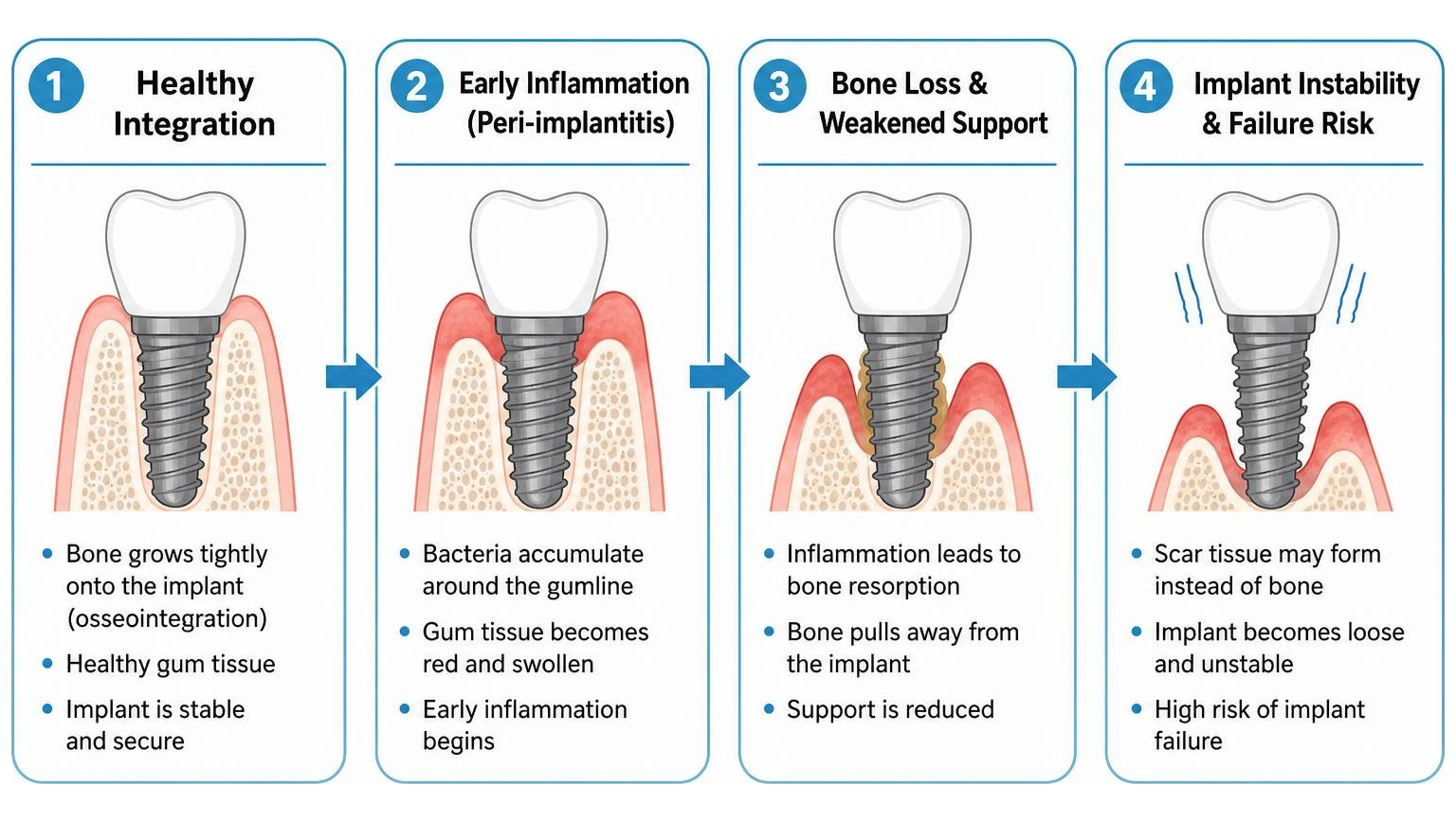 Four-phase progression from healthy integration to implant instability