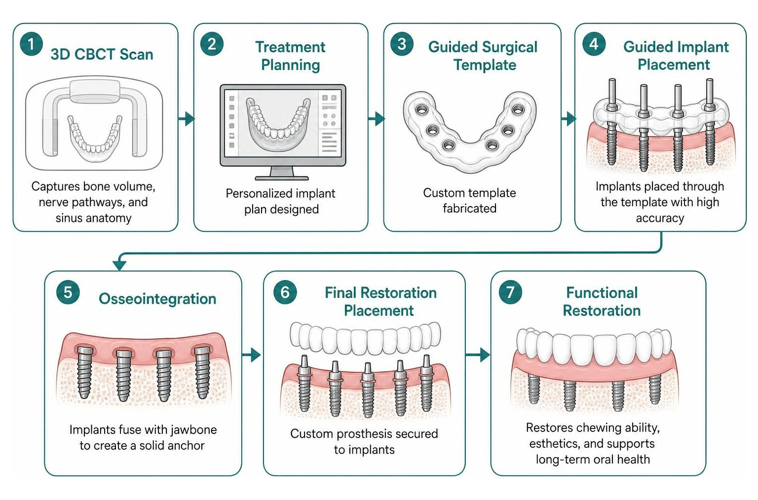 full mouth dental implant workflow from 3D scan to placement full mouth dental implant workflow from 3D scan to placement