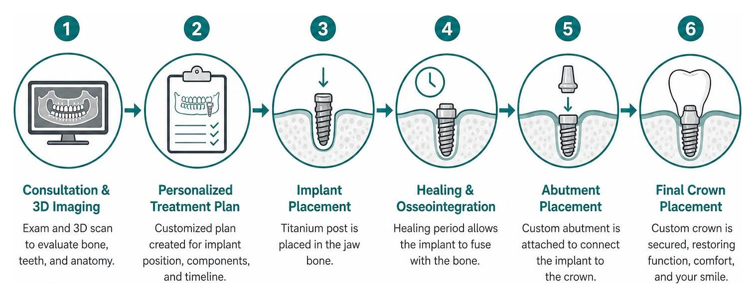 Timeline of the dental implant process from planning to final crown placement