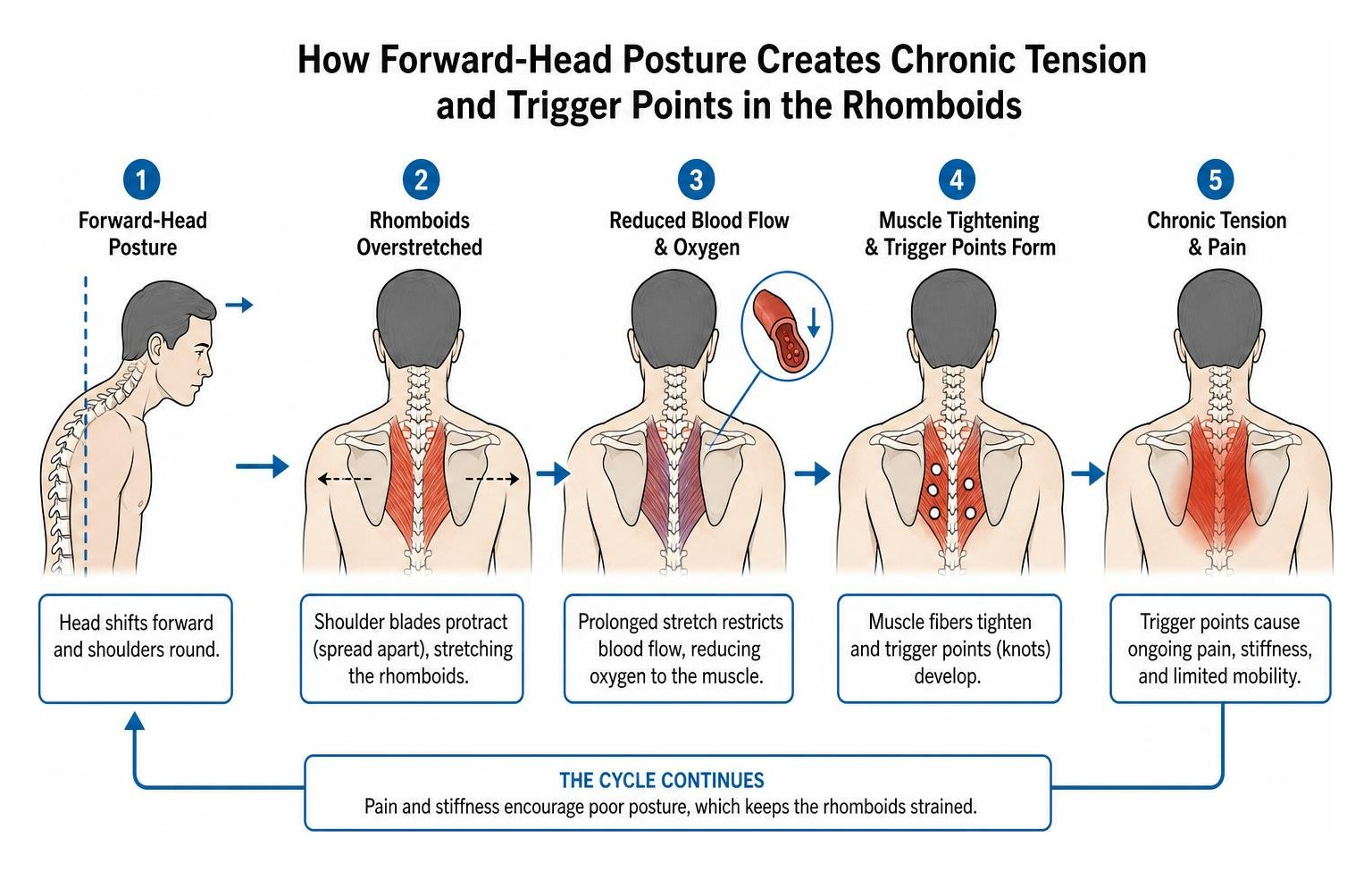 Diagram showing how forward-head posture creates chronic tension and trigger points in the rhomboids