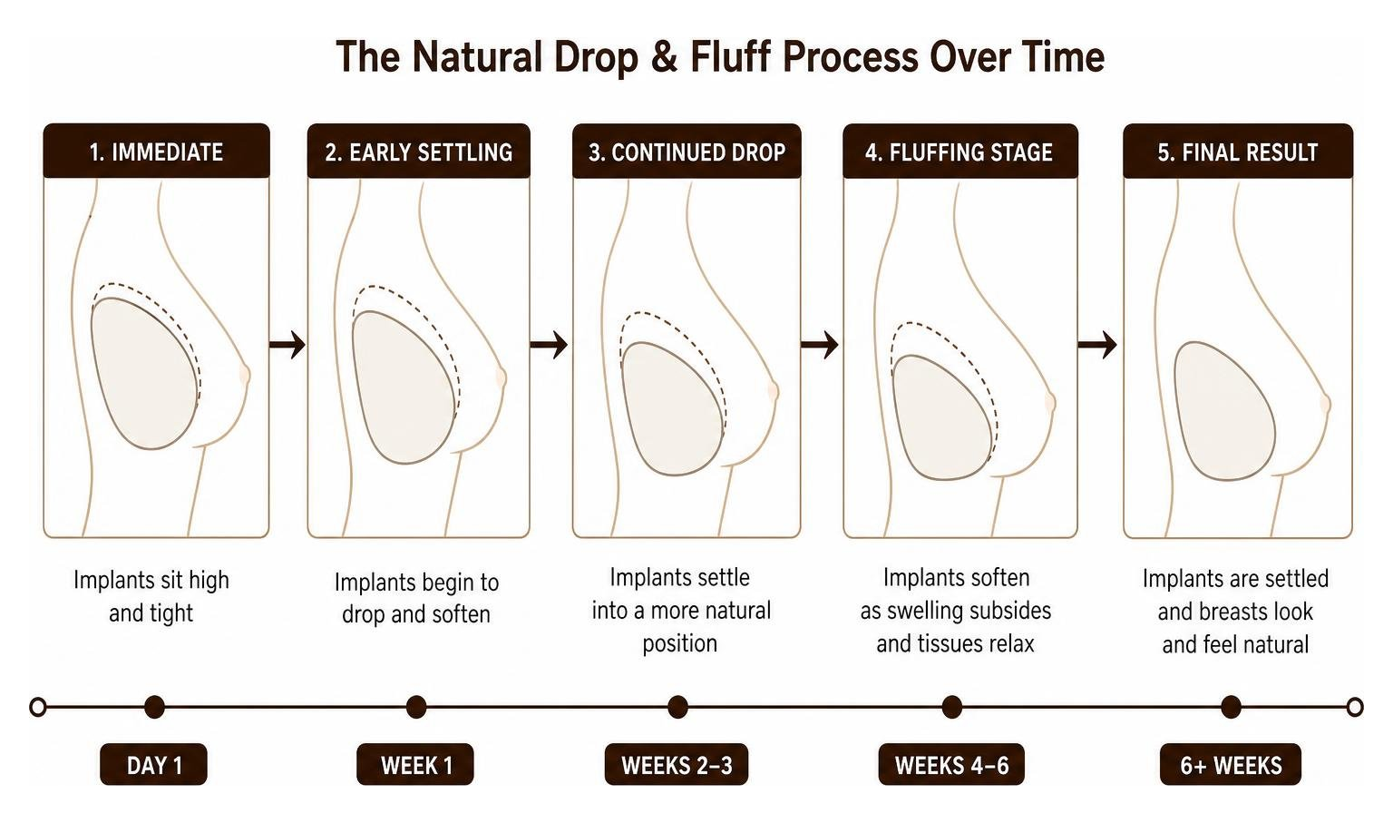 Diagram showing the natural drop and fluff process of breast implants over time