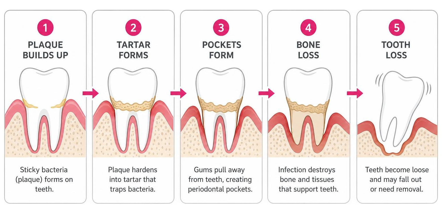Diagram showing how plaque leads to tartar, pocket formation, bone loss, and tooth loss