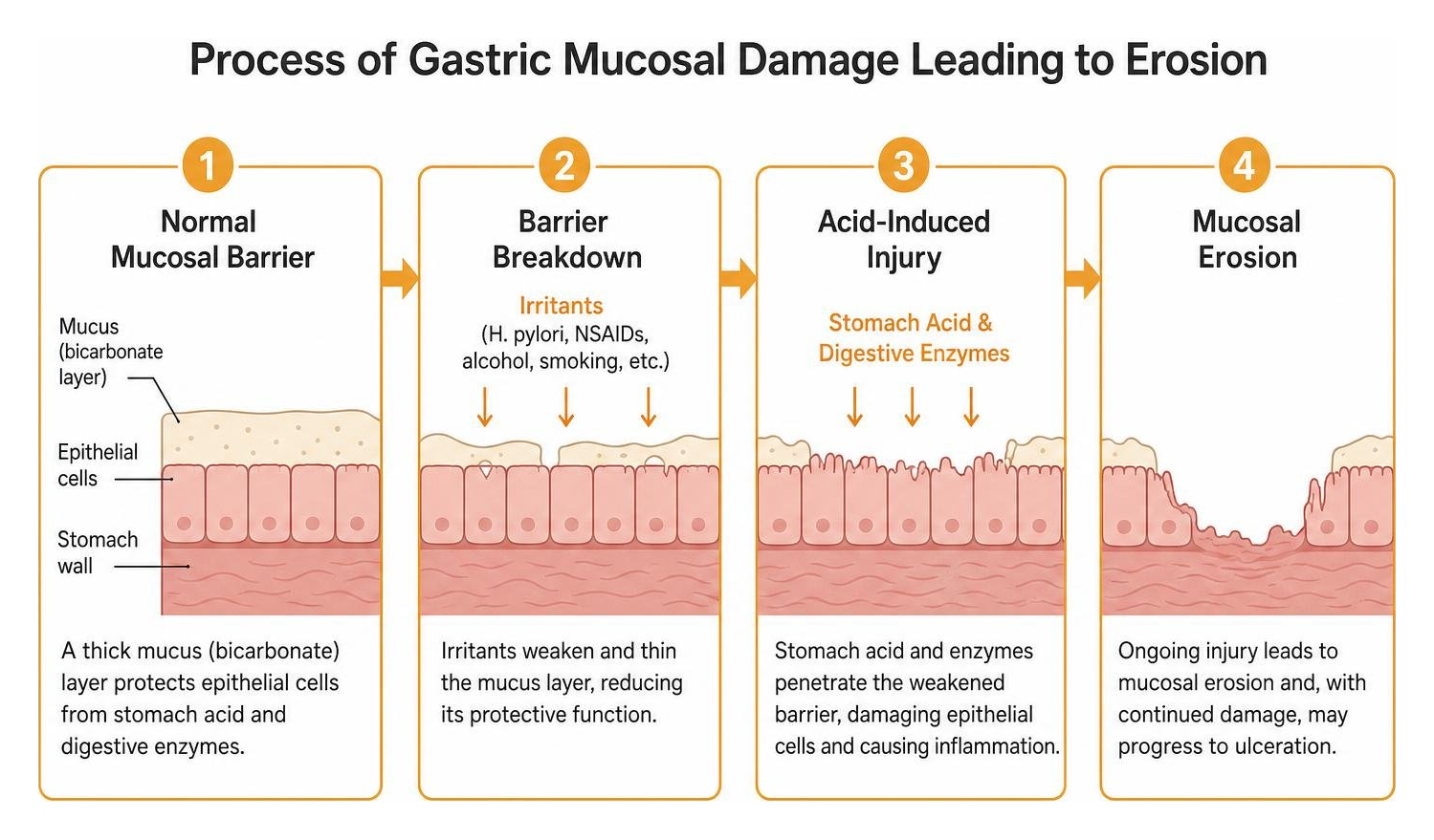 Process of gastric mucosal damage leading to erosion Process of gastric mucosal damage leading to erosion