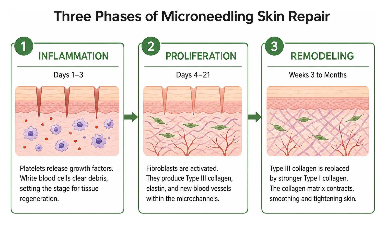 Three phases of microneedling skin repair: inflammation, proliferation, and remodeling Three phases of microneedling skin repair: inflammation, proliferation, and remodeling