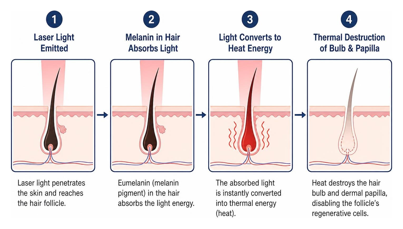 selective photothermolysis hair destruction sequence selective photothermolysis hair destruction sequence