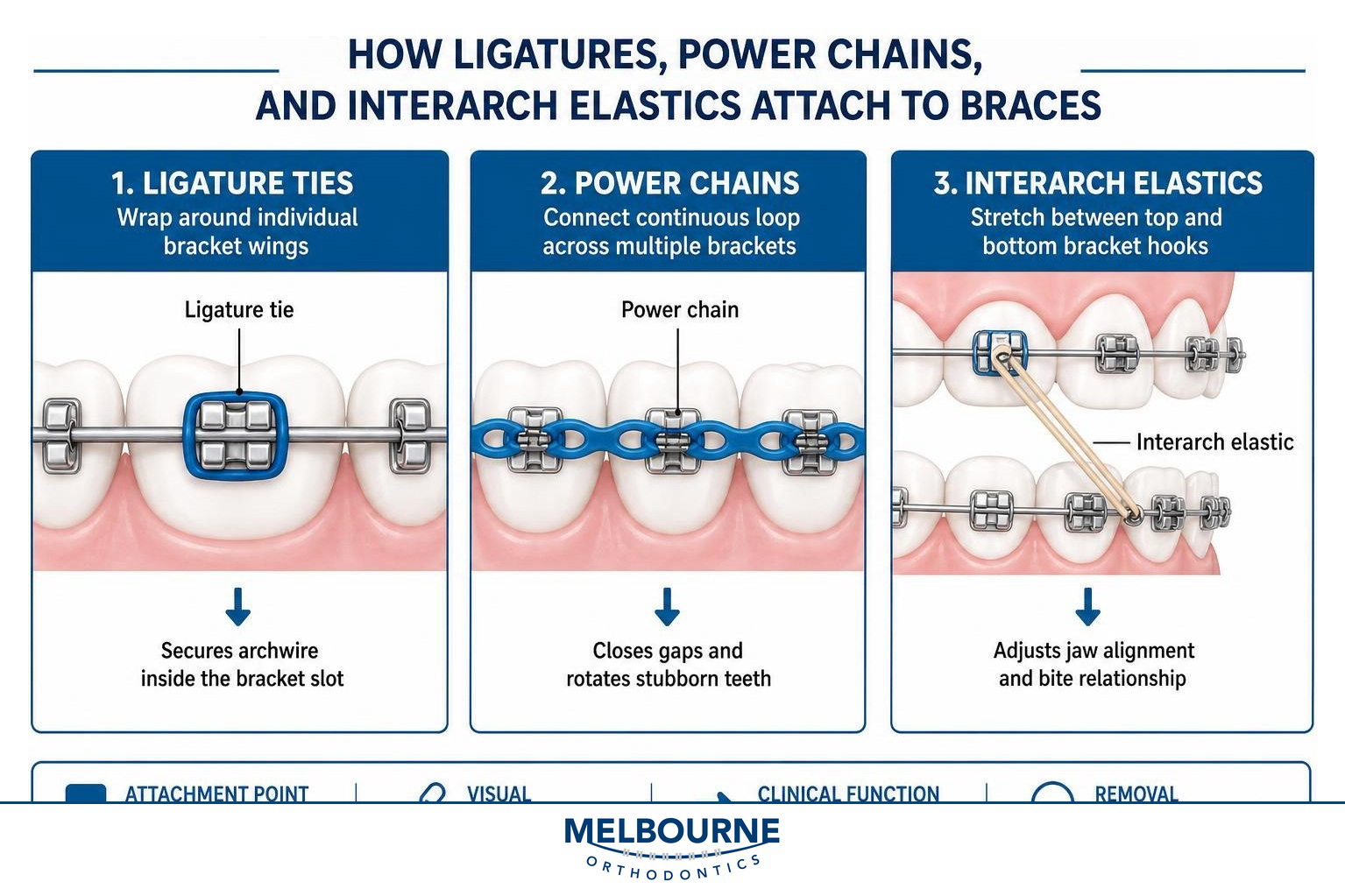 Diagram showing how ligatures, power chains, and interarch elastics attach to braces