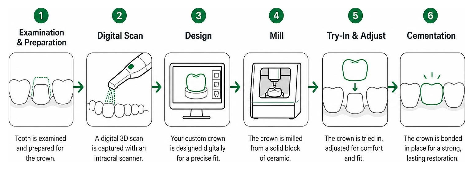 Step-by-step process of getting a CEREC same-day crown
