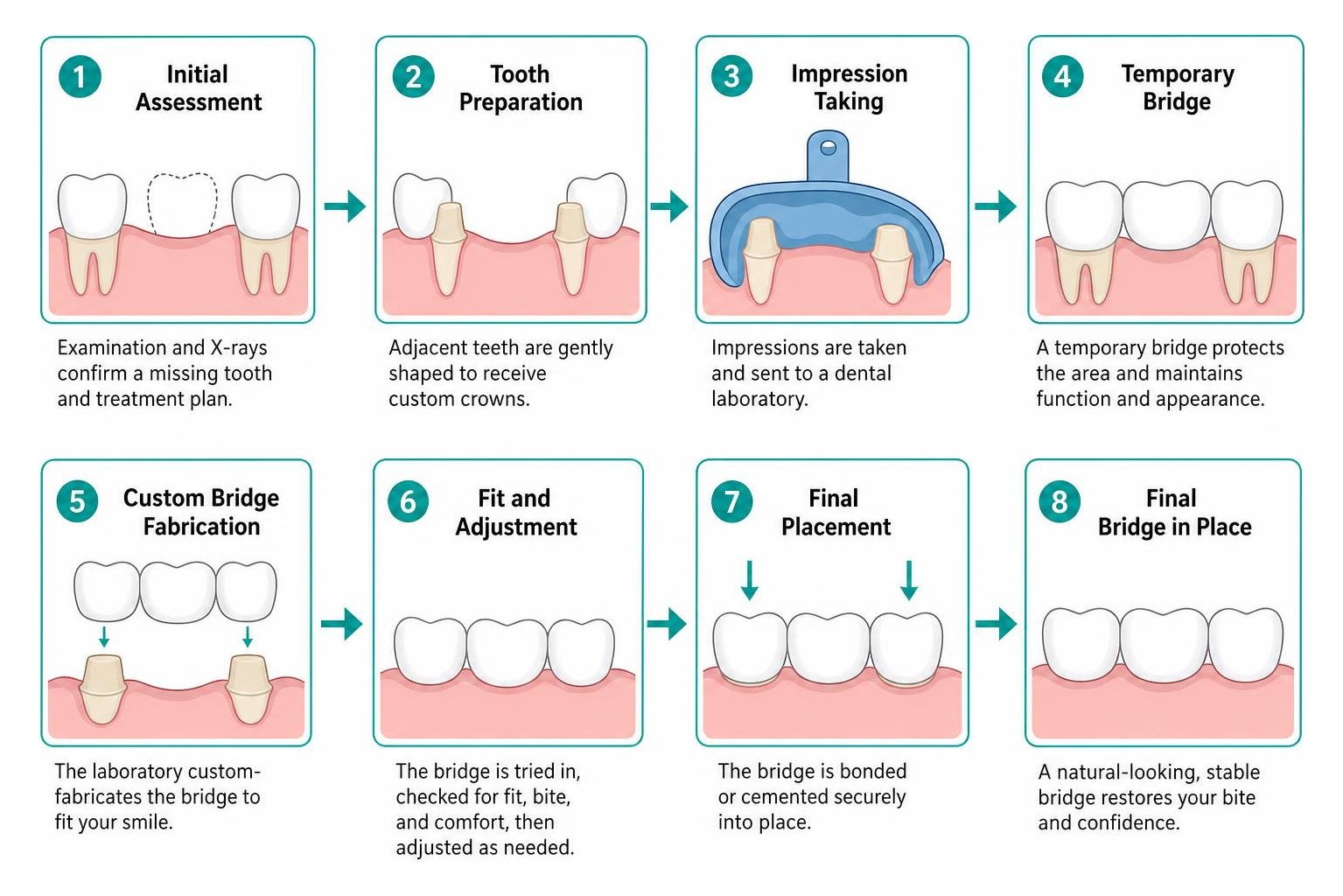 step by step clinical workflow from tooth preparation to final bridge placement