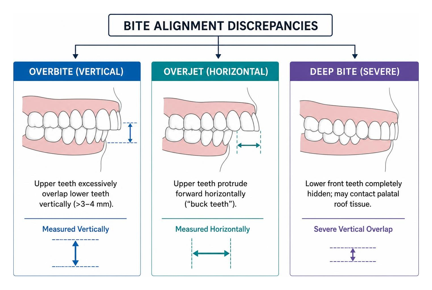 Comparison framework illustrating vertical overbite, horizontal overjet, and deep bite Comparison framework illustrating vertical overbite, horizontal overjet, and deep bite