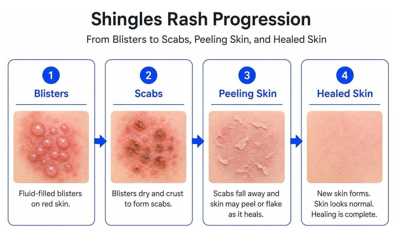 Shingles rash progression from blisters to scabs, peeling skin, and healed skin Shingles rash progression from blisters to scabs, peeling skin, and healed skin