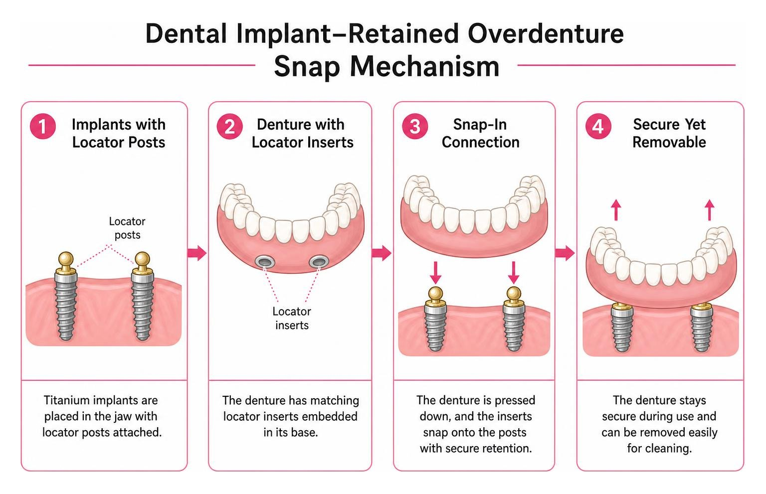 Dental implant retained overdenture snap mechanism