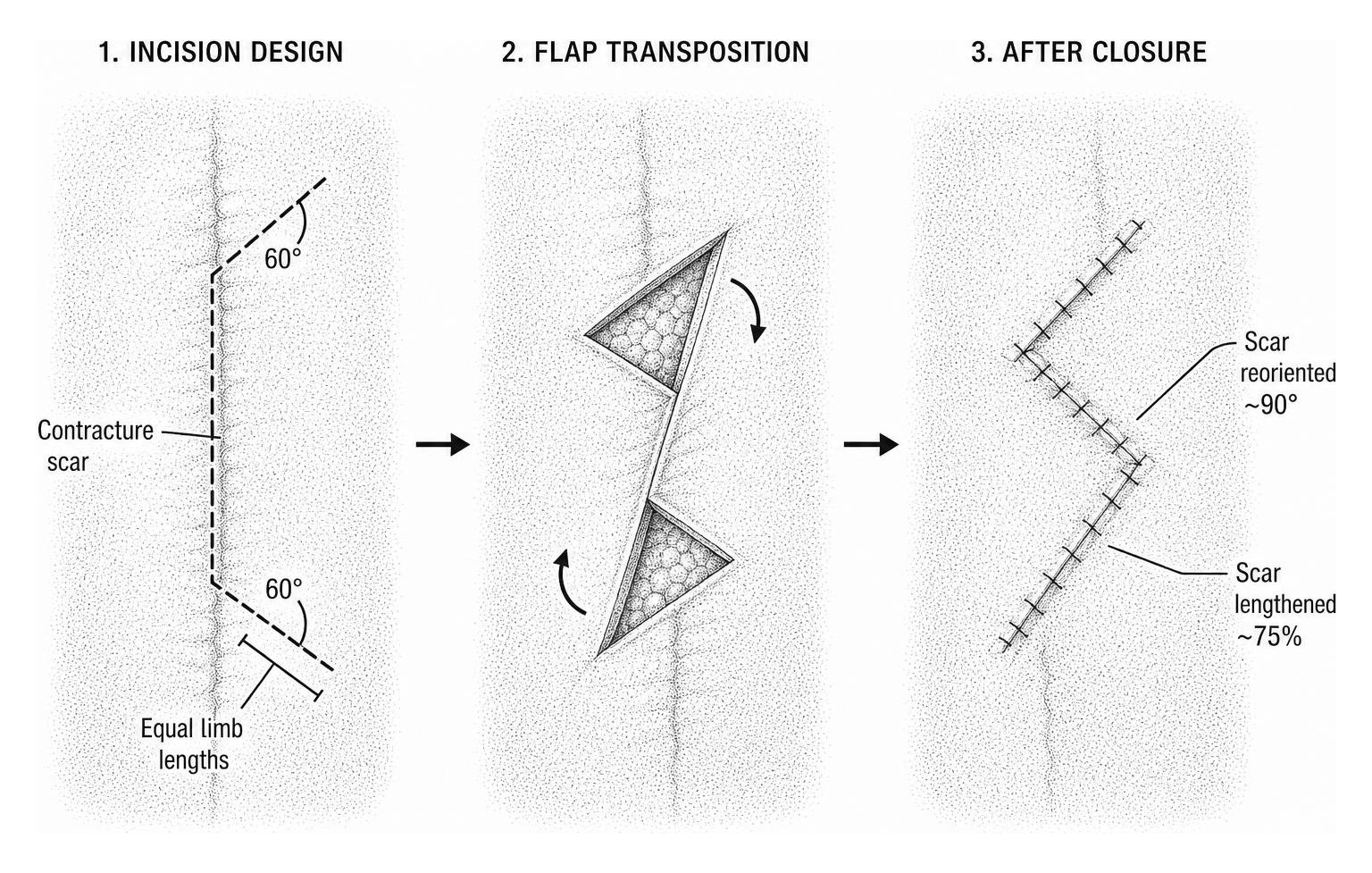 stippled diagram of a 60 degree z-plasty incision and transposition