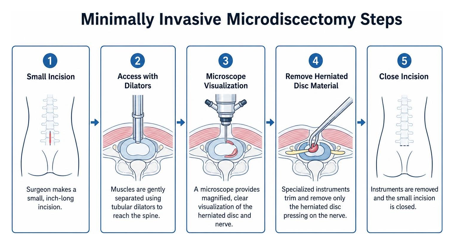 Minimally invasive microdiscectomy steps