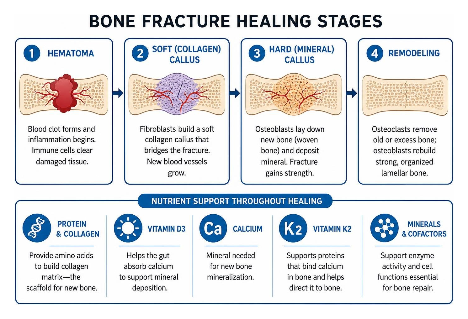 Diagram of bone fracture healing stages from hematoma to collagen callus and mineral remodeling