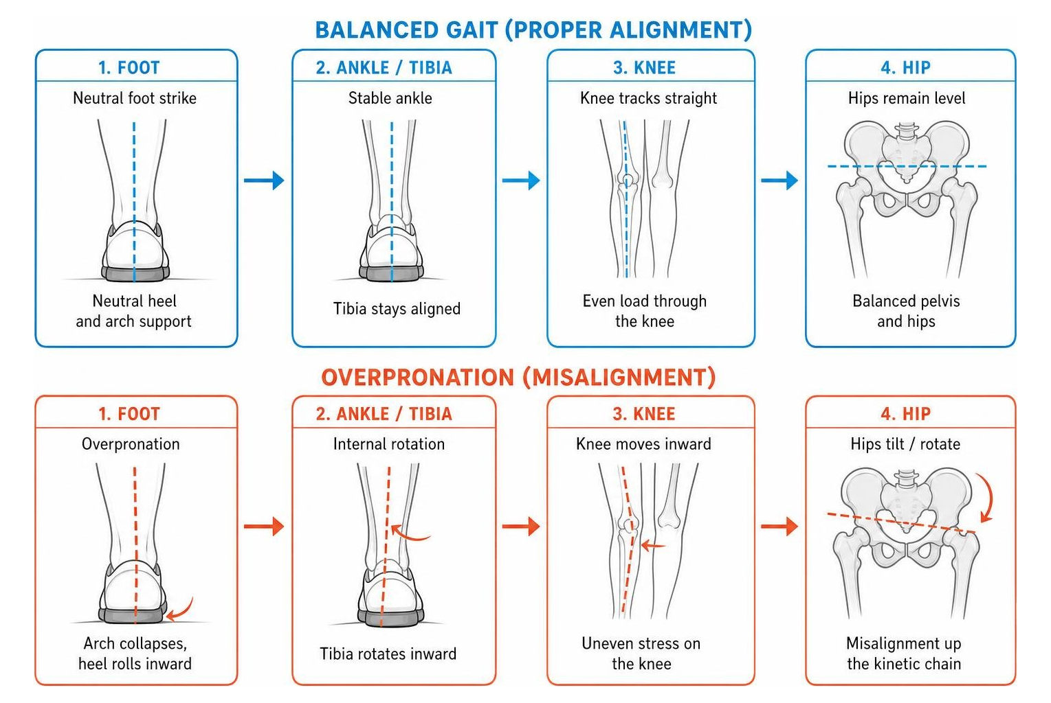 Kinetic chain alignment diagram comparing balanced gait versus overpronation impact on knees and hips Kinetic chain alignment diagram comparing balanced gait versus overpronation impact on knees and hips