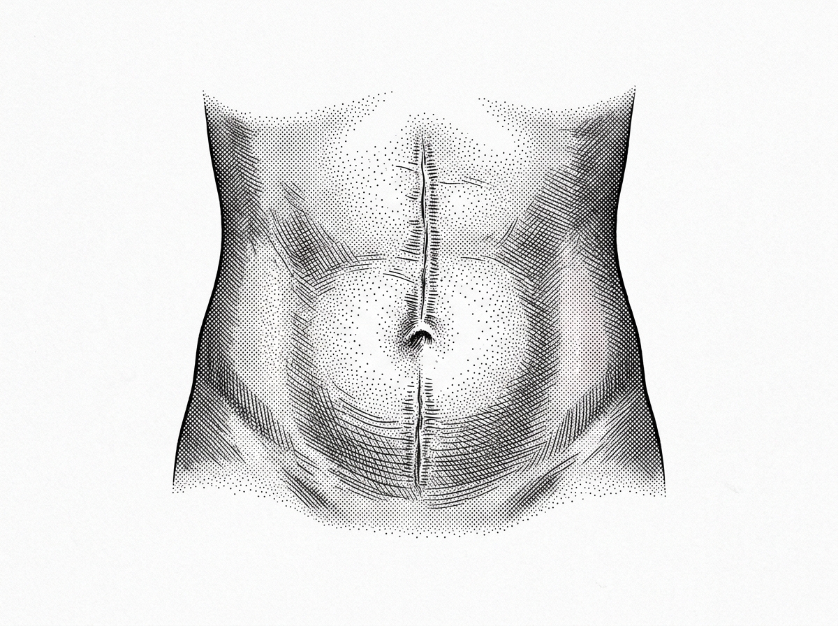 A Guide to Minimizing and Managing Abdominal Surgical Scars