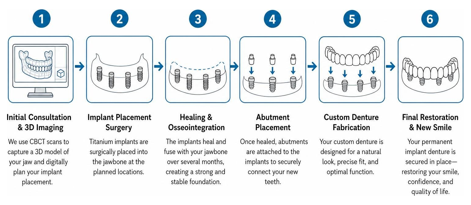 Diagram of the complete permanent implant denture process from consultation to final restoration