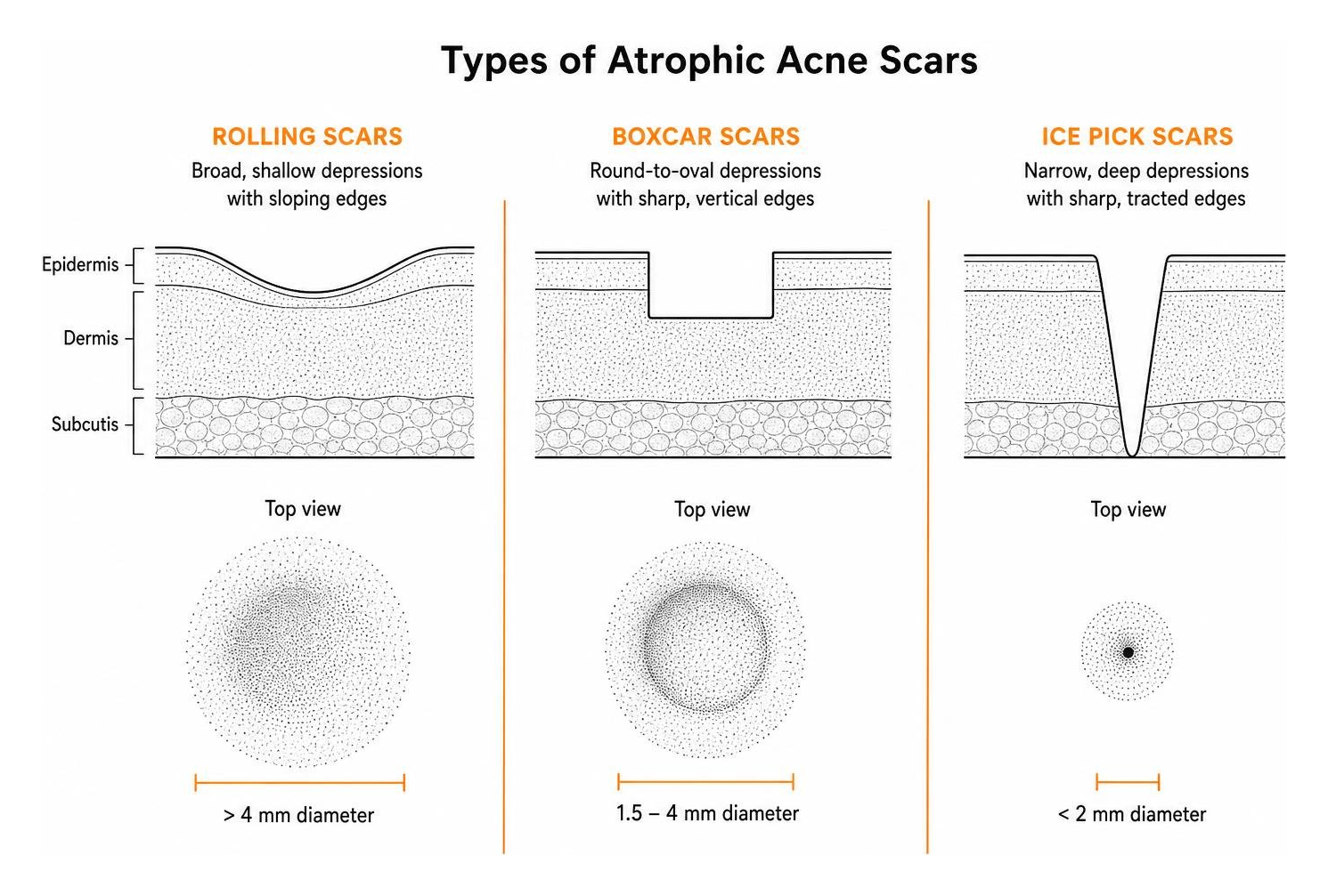 stippled diagram of rolling boxcar and ice pick scars stippled diagram of rolling boxcar and ice pick scars