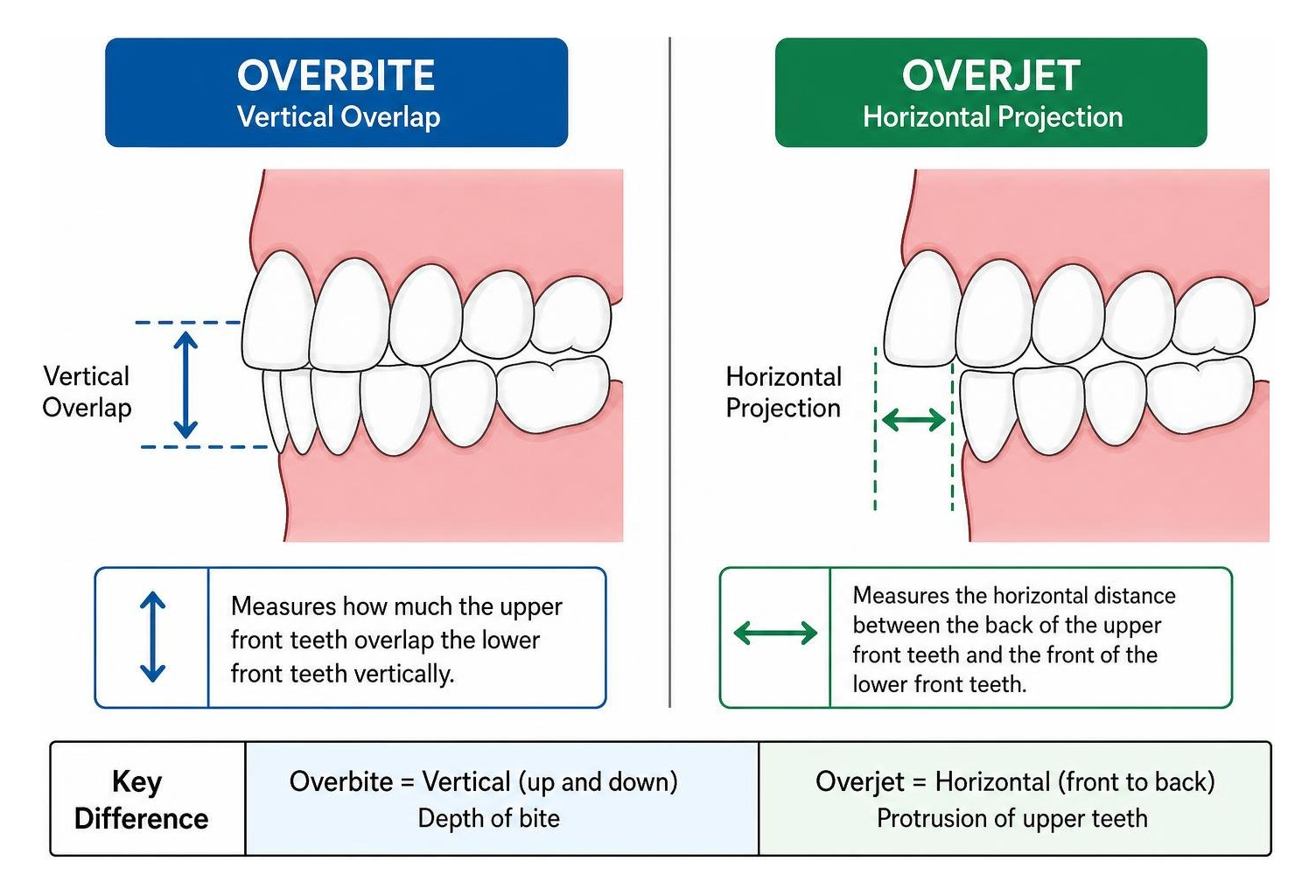 Diagram showing vertical distance overbite versus horizontal distance overjet Diagram showing vertical distance overbite versus horizontal distance overjet