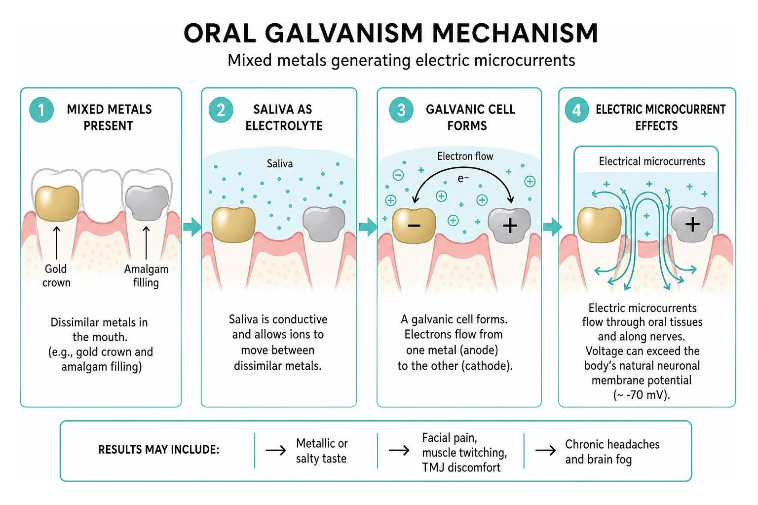 Oral galvanism mechanism showing mixed metals generating electric microcurrents Oral galvanism mechanism showing mixed metals generating electric microcurrents