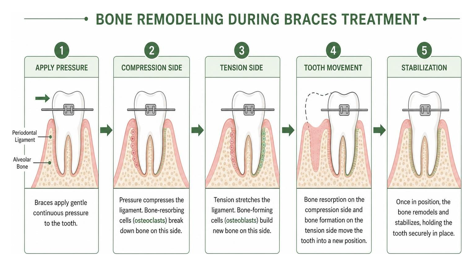 Diagram showing the bone remodeling process during braces treatment
