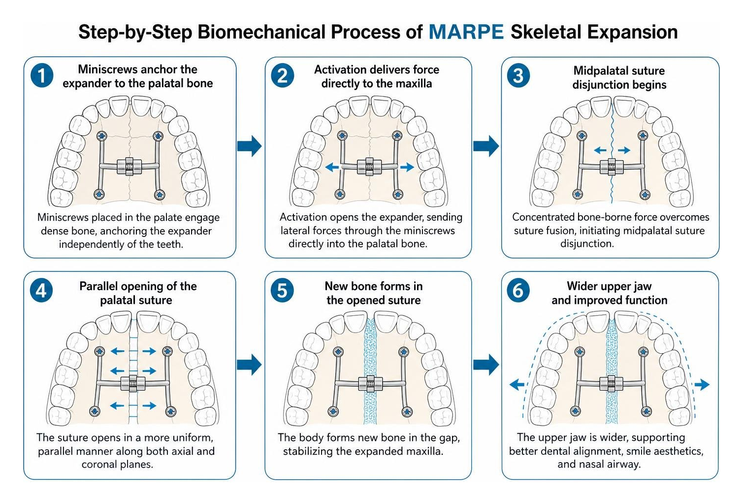 Step-by-step biomechanical process of MARPE skeletal expansion