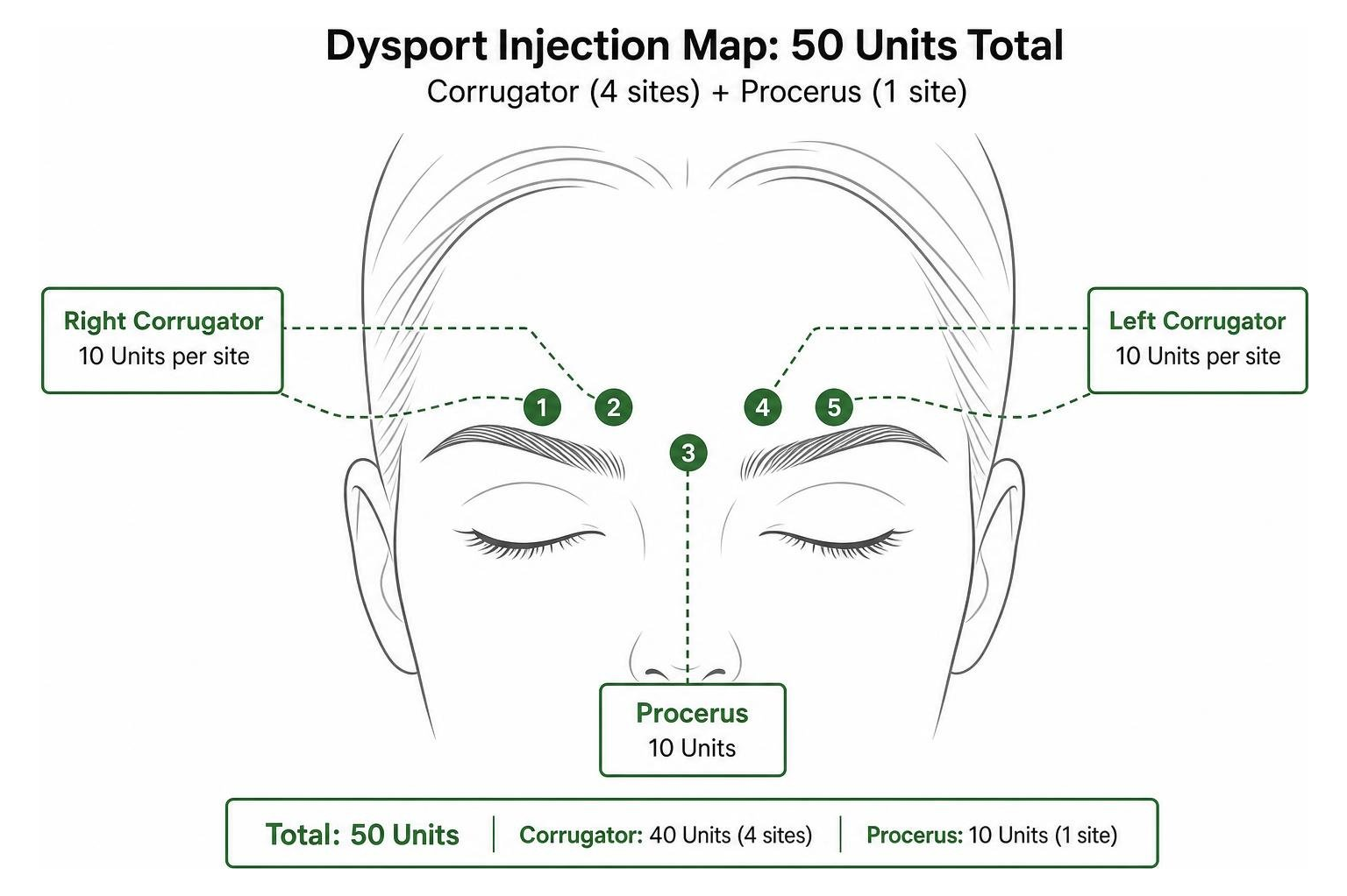 Diagram showing five precise injection sites for 50 Units of Dysport in corrugator and procerus muscles Diagram showing five precise injection sites for 50 Units of Dysport in corrugator and procerus muscles