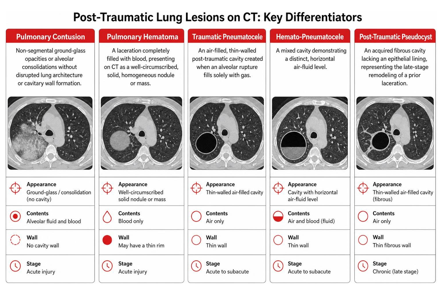 Diagram comparing pulmonary contusion, hematoma, pneumatocele, and pseudocyst on CT Diagram comparing pulmonary contusion, hematoma, pneumatocele, and pseudocyst on CT