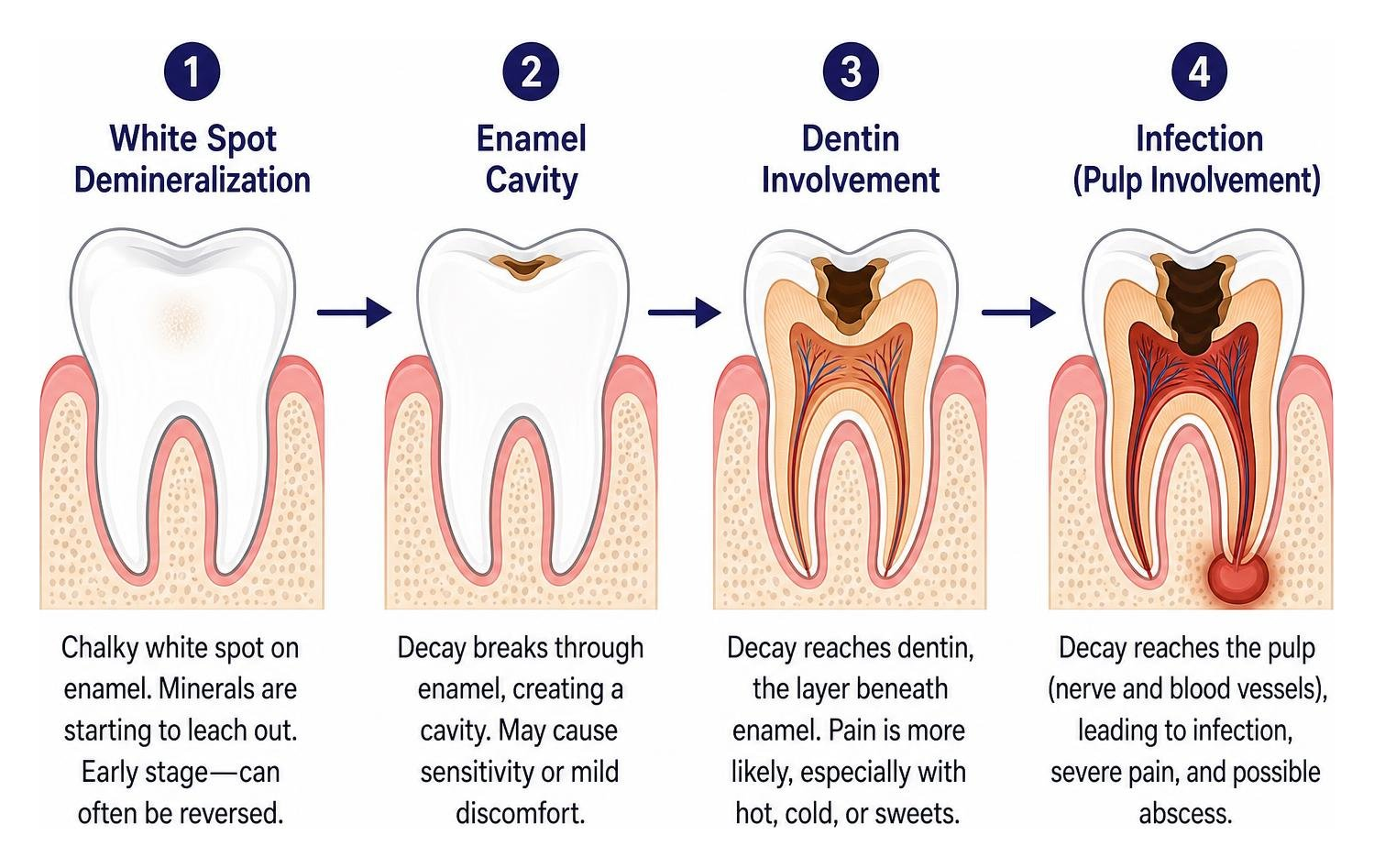 Stages of tooth decay from white spot demineralization to enamel cavity and dentin infection