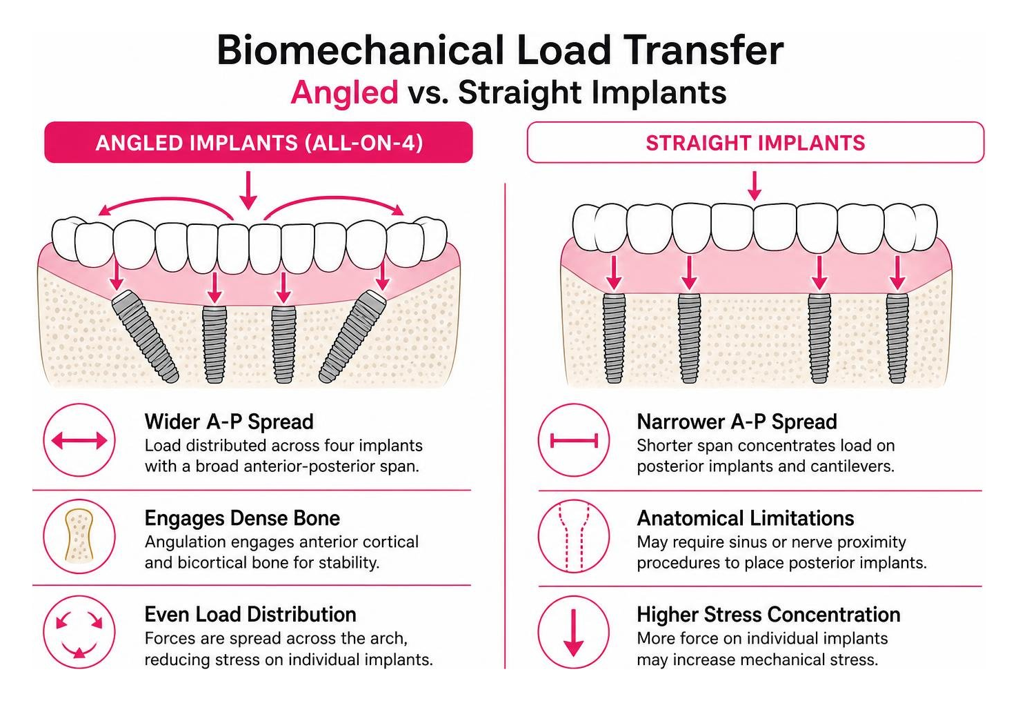 Biomechanical load transfer in angled versus straight implants