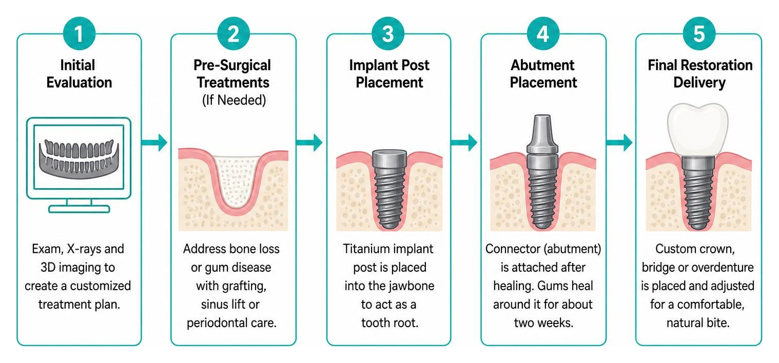 Step by step process of getting dental implants Step by step process of getting dental implants