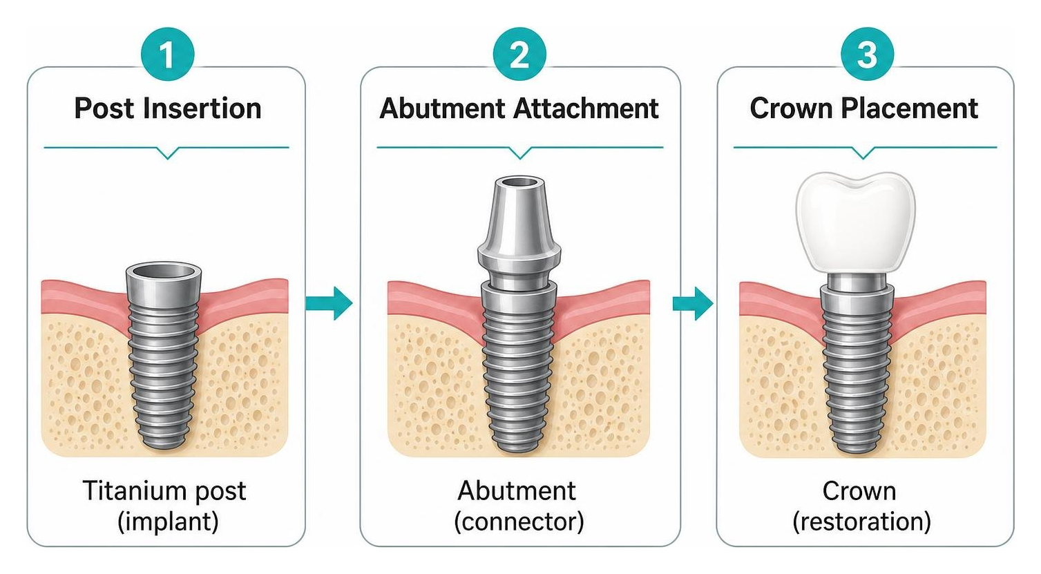 Diagram of dental implant three component assembly process post insertion abutment attachment crown placement Diagram of dental implant three component assembly process post insertion abutment attachment crown placement