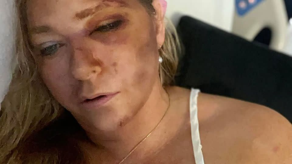 Virginia Giuffre hospitalizada con lesiones faciales