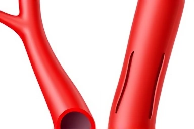 Healthy vs. subtly narrowed artery comparison.