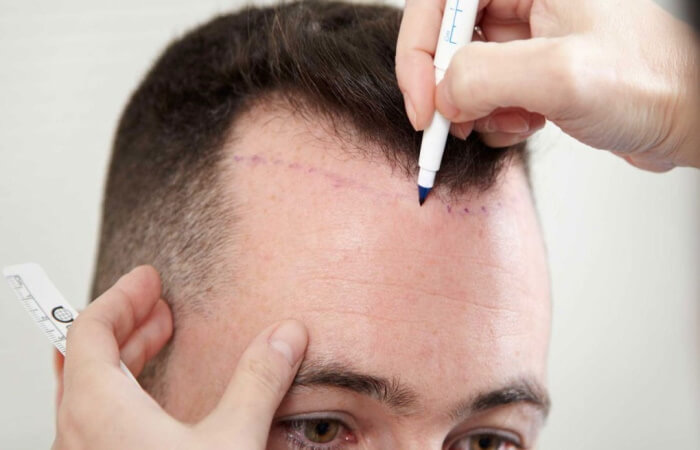 إغلاق مركز شهير لزراعة الشعر لارتكابه مخالفات جسيمة - جريدة الغد