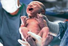 الولادة القيصرية.. الدواعي والمخاطر