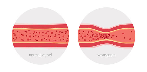 Narrower-arteries-mean-higher-blood-pressure