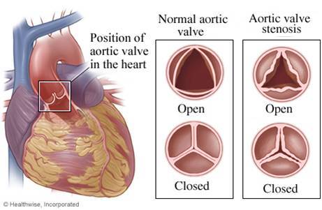 主動脈瓣隨年齡增長鈣化，主動脈開口變小，心臟負荷增加，將引發胸悶、胸痛，甚至心臟衰竭的情形。（photo by台北榮民總醫院）