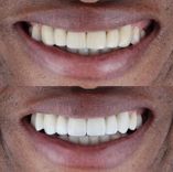 image dentiste Implant dentaire Turquie Istanbul