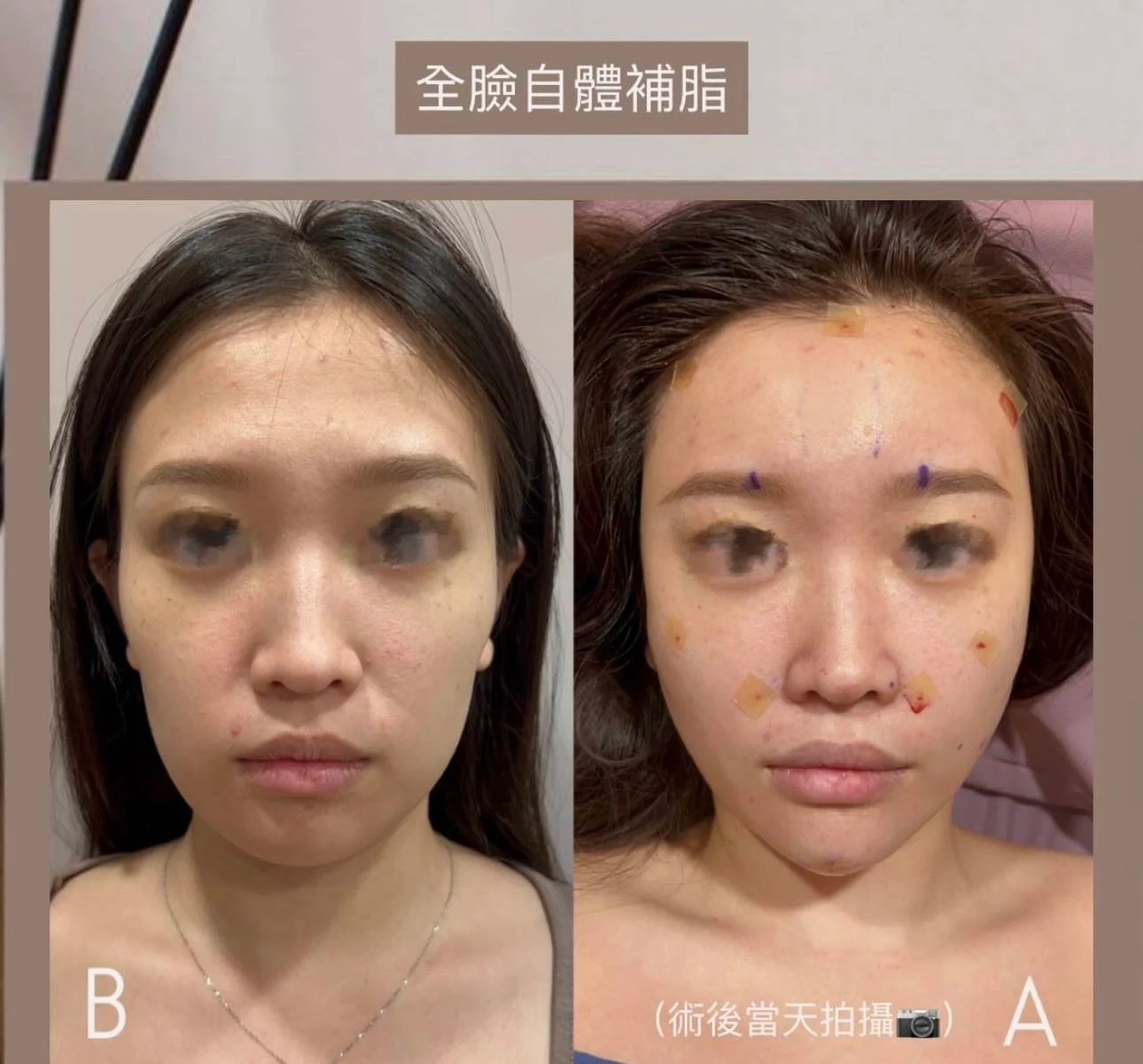 自體補脂｜全臉容量與輪廓