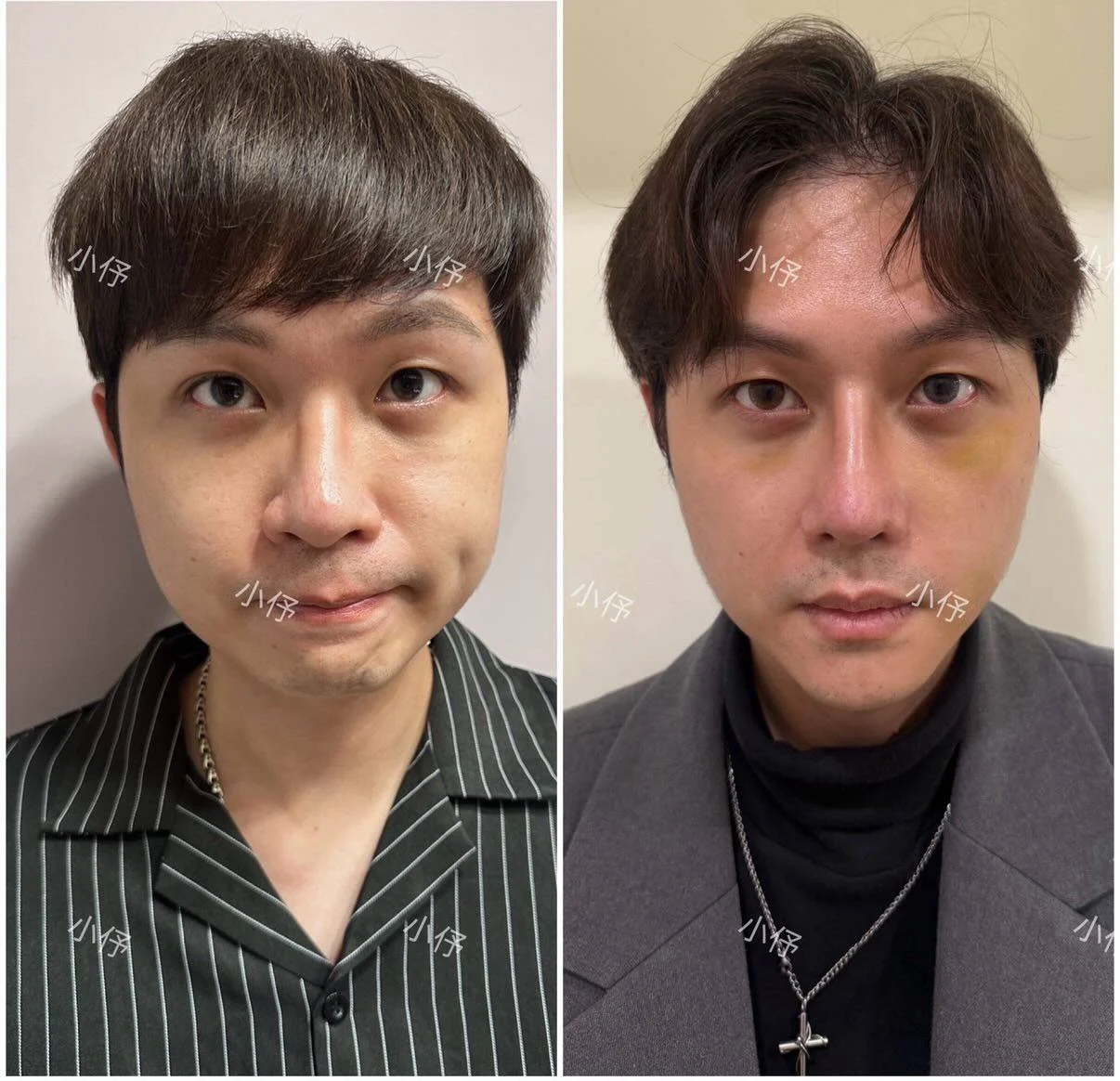 鼻整形｜正面比例與左右差異